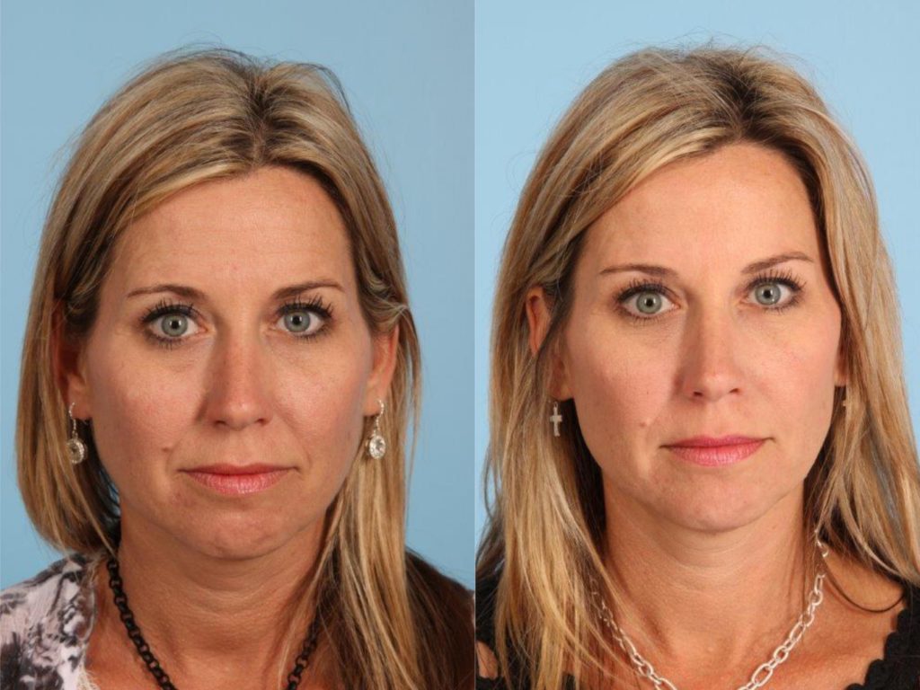 mdaesthetica-before-after-botox