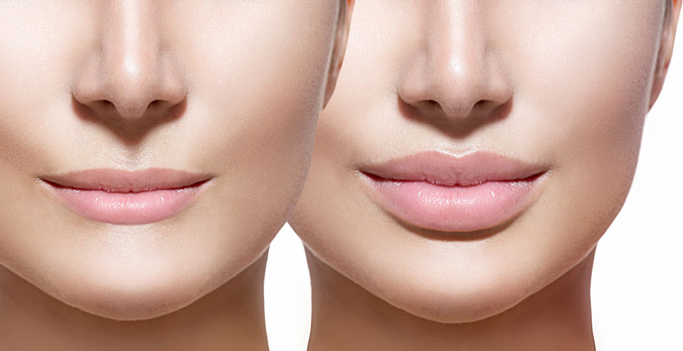 Juvederm in Houston